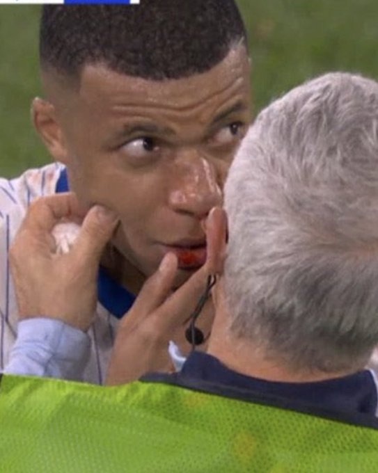 Mbappe's nose appeared to be broken following the collision